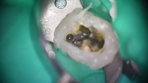 Cas clinique d'endodontie avec activation d'NaOCl par LASER en mode SWEEPS